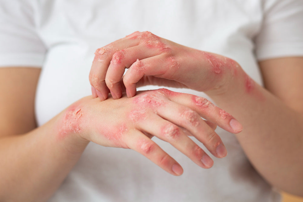 Najbolji topikalni preparati za lečenje psorijaze: šta treba da znate