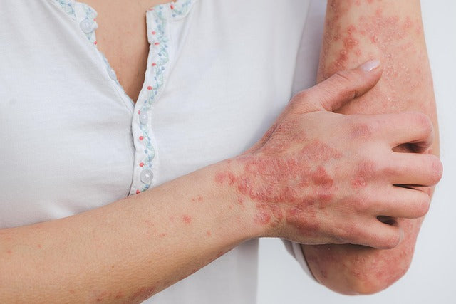 Zašto se psorijaza vraća i kako držati simptome pod kontrolom